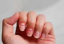 Nëse ju zhduken këto gjysmëhëna në thonj, mund të jetë shenjë e hershme e sëmundjes