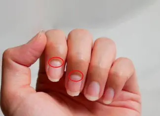 Nëse ju zhduken këto gjysmëhëna në thonj, mund të jetë shenjë e hershme e sëmundjes