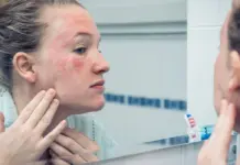 Stresi kronik mund t’ju ndezë lëkurën: Shkencëtarët zbulojnë si shfaqet ekzema