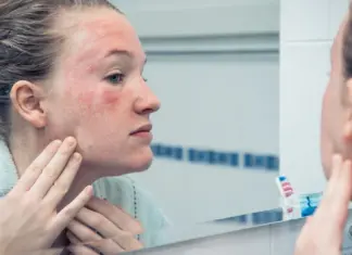 Stresi kronik mund t’ju ndezë lëkurën: Shkencëtarët zbulojnë si shfaqet ekzema